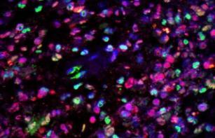 Glioblastoma under microscope with dyes. Credit: Brain Tumour Research Centre of Excellence at Queen Mary University of London