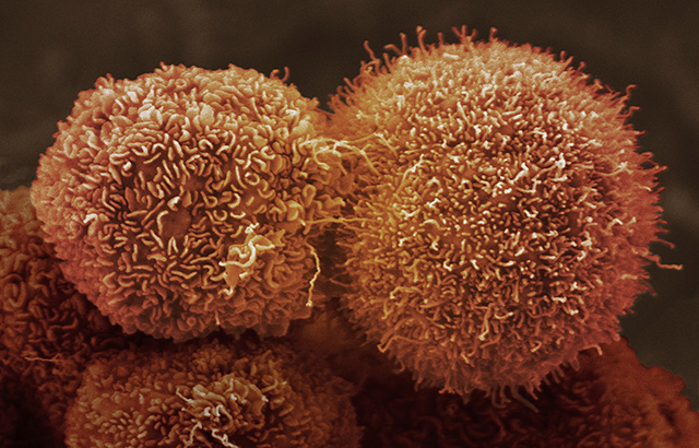 Pancreatic cancer cells. CC BY-NC Credit: Anne Weston, Francis Crick Institute
