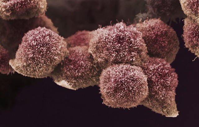 Pancreatic cancer cells grown in culture, SEM. Credit: Anne Weston, Francis Crick Institute. Attribution-NonCommercial 4.0 International (CC BY-NC 4.0)