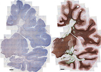 Examples of two MS brain slices stained to show different compounds