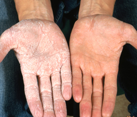 An image demonstrating the appearance of hands following immersion in water