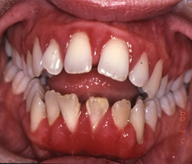 Gum disease leads to painful gums and the loosening of teeth