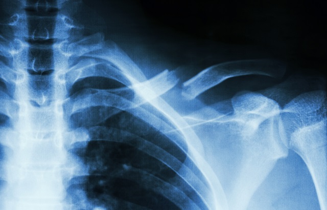 Image of left clavicle fracture