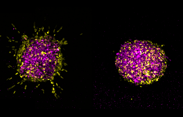 3D spheres of cancer cells (shown in purple) and stellate cells (shown in yellow). In untreated conditions (shown in the left panel of the image), stellate cells invade into the surrounding tissue, creating tracks for the cancer cells to follow. When treated with an FGFR inhibitor (shown in the right panel), this invasion is blocked and the cells remain in the central sphere