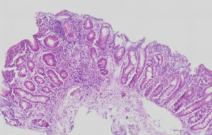 Small intestinal biopsy from child with refractory stunting