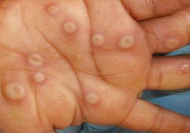 Typical Monkeypox rash on hand