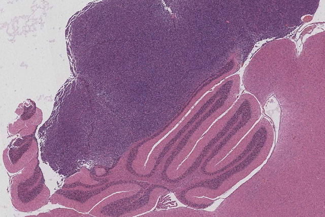 Microscope image of medulloblastoma