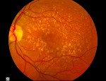 A photo showing intermediate age-related macular degeneration. Credit: National Institutes of Health