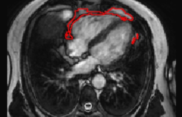 Heart MRI scan showing the area of fat detected by the AI tool