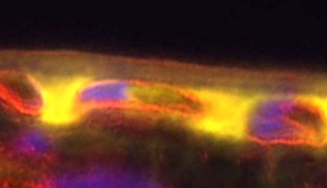 Accumulation of FHR-4 protein (yellow) within the macula 