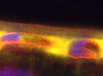 Accumulation of FHR-4 protein (yellow) within the macula
