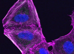 A drug resistant melanoma cell that has altered its cytoskeleton