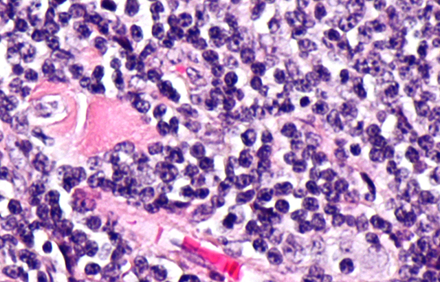 Micrograph showing follicular lymphoma