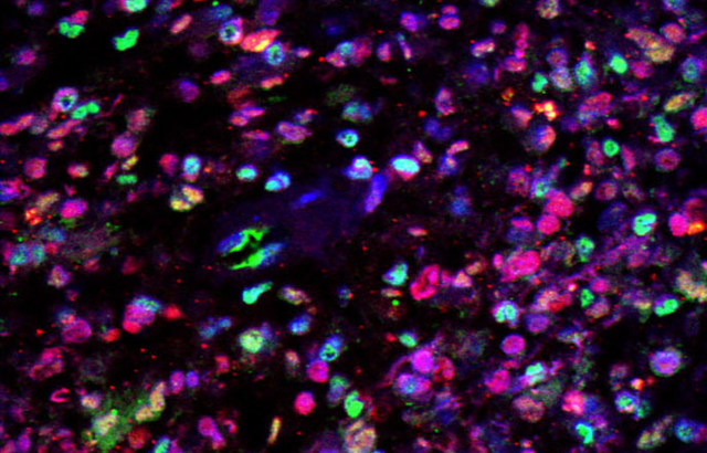 Glioblastoma under microscope with dyes. Credit: Brain Tumour Research Centre of Excellence at Queen Mary University of London