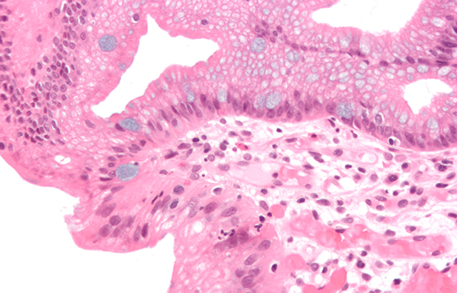 High-magnification micrograph of Barrett's oesophagus 