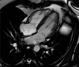An MRI scan of the heart