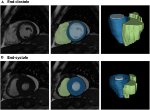 Radiomics analysis of cardiac MRI scans.