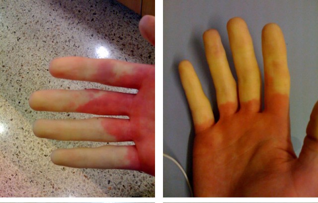 Researchers find genetic cause of Raynaud's phenomenon - Queen