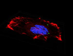 A cancer cell which has taken up microparticles developed by BioMoti