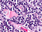 Micrograph showing follicular lymphoma