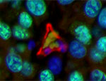 Tumour blood vessel endothelial cells (red), surrounded by tumour cell nuclei (blue and green). Red blood cells (green shapes) are visible in the centre of the blood vessel 