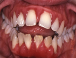 Gum disease leads to painful gums and the loosening of teeth