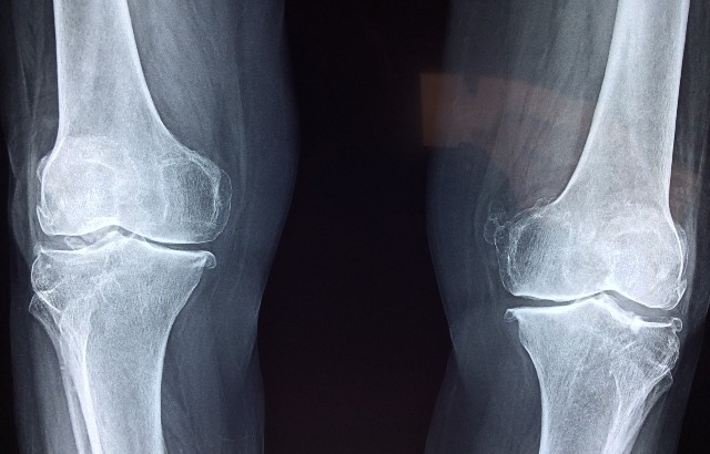 Knee x-ray. Image by Dr. Manuel González Reyesa from pixabay