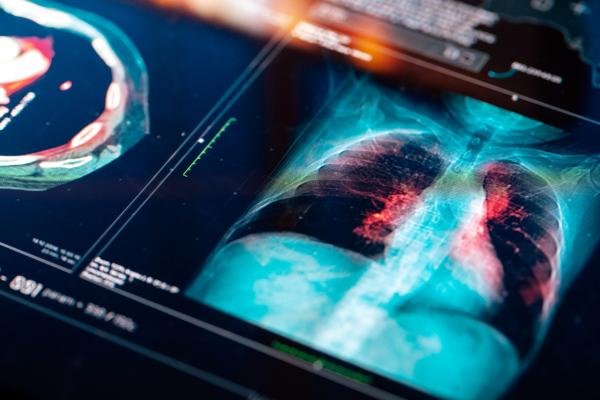 Image of - How cancer screening is changing - and what comes next