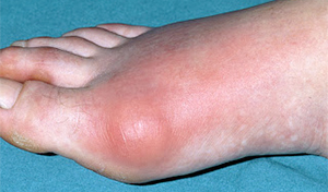 Early Gout changes - foot with Gout