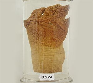 Specimen B224 - hand affected by Gout