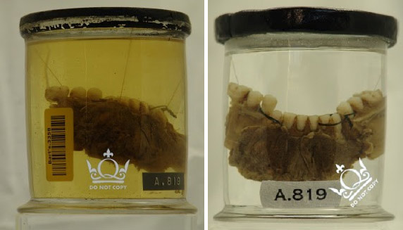 Fracture of mandible (Bi-lateral), before and after