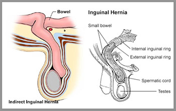 Inguinal Hernia