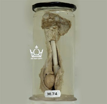 M.74 Inguinal Hernia (The oldest specimen in the museum) 1750