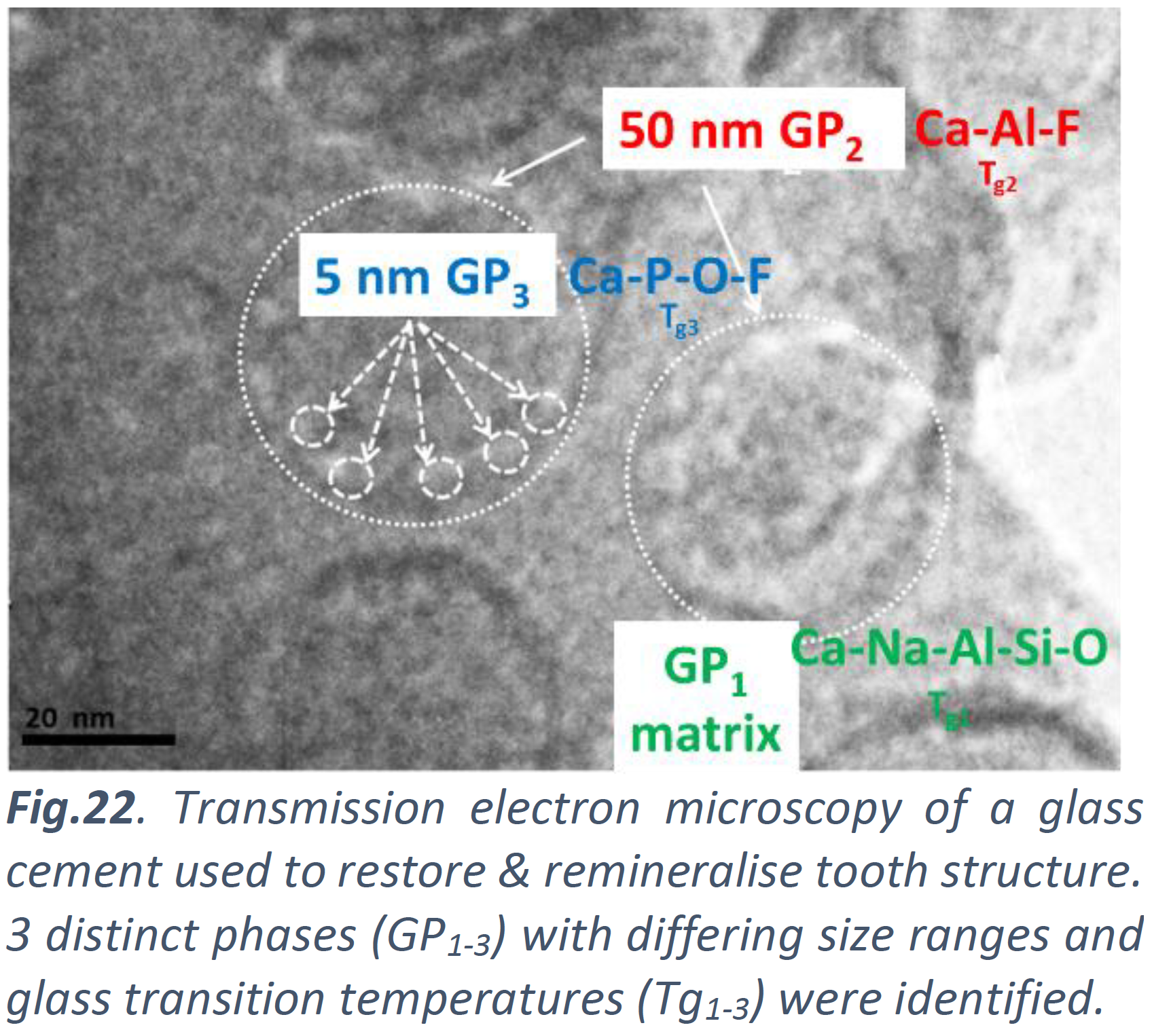 Transmission electron microscopy of a glass cement used to restore & remineralise tooth structure. 3 distinct phases with differing size ranges and glass transition temperatures were identified.