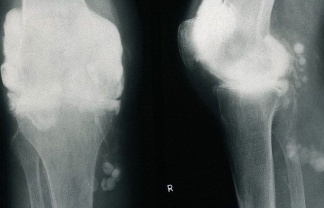 Rheumatoid arthritis of knee