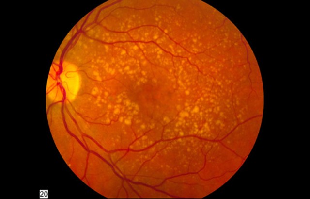 A photo showing intermediate age-related macular degeneration