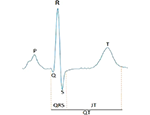 Annotation of an example ECG signal