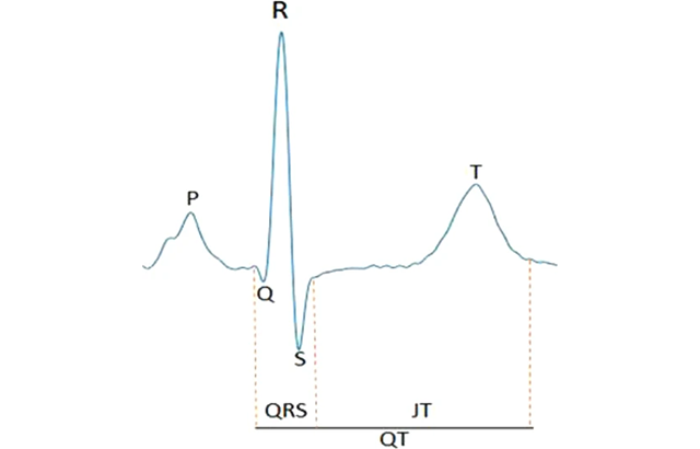Annotation of an example ECG signal