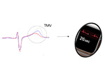 T- wave morphology variations on the ECG signal could enable large-scale screening to predict SCD risk using smartwatches.