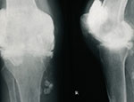 Rheumatoid arthritis of knee 