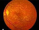 A photo showing intermediate age-related macular degeneration.