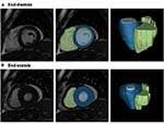 Radiomics analysis of cardiac MRI scans