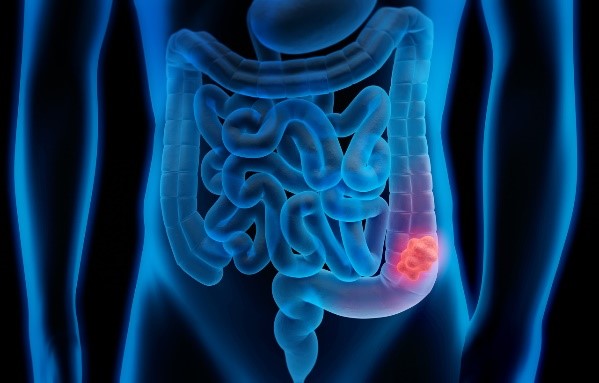 An illustration of the human bowel, with a tumour shown as a red mass growing in the bowel.